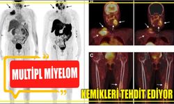 MULTİPL MİYELOM KEMİKLERİ TEHDİT EDİYOR