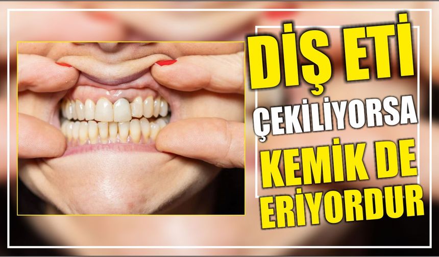 Diş eti çekiliyorsa kemik de eriyordur